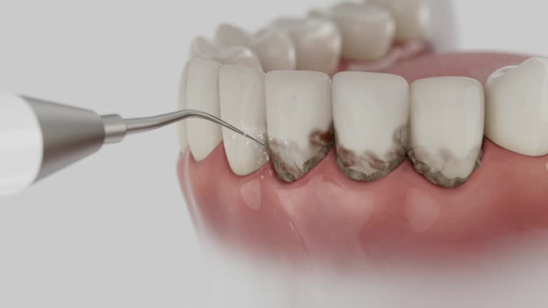 Trusted Wisdom Tooth Removal service in Bratenahl, OH - Dentist Open Now
